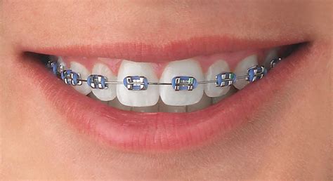 azul metalico brackets|colores de brackets metalicos.